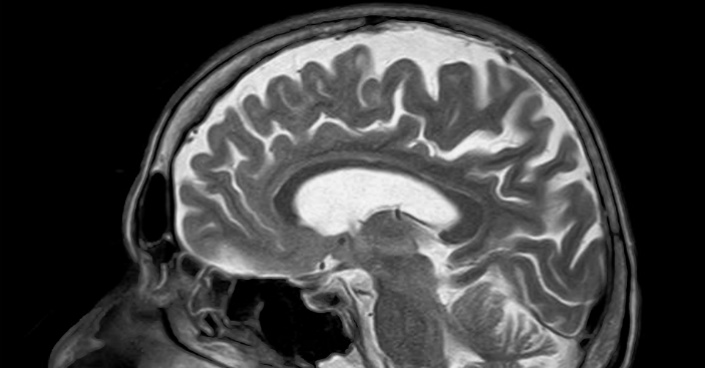 Brain MRI