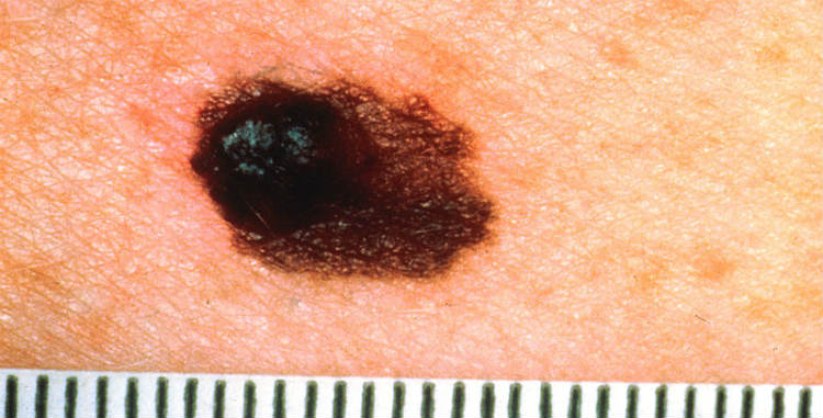 Melanoma Cancer