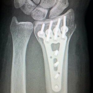 arm xray ith titanium plate