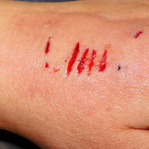 dog bite on hand