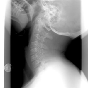 xray neck injury