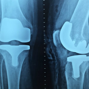 xray of knees